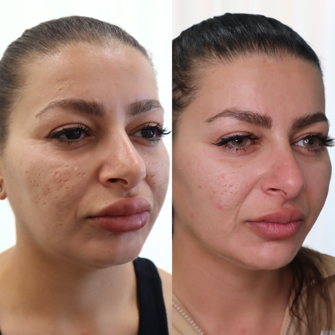 Bio-Stimulator - Injxu Cosmetics | Aesthetics Clinic in Sydney